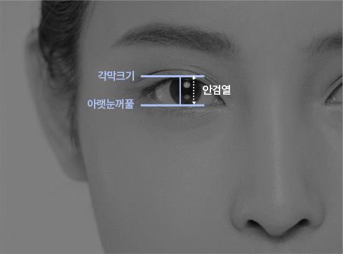위눈꺼풀과 아래눈거풀과의 거리인 안검열을 측정하여 렌즈의 움직임과 눈물의 순환, 착용감을 원할하게 하는 렌즈를 처방합니다.