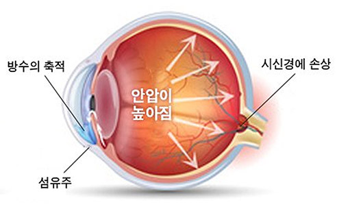 녹내장