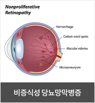 비증식성 당뇨망막병증