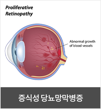 증식성 당뇨망막병증