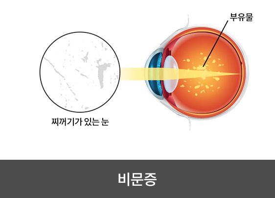 비문증