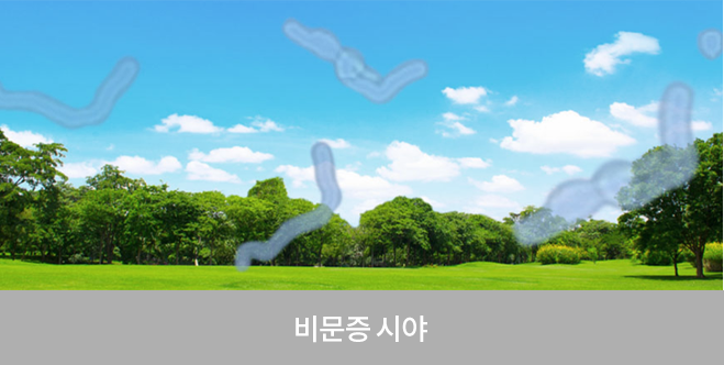 비문증 시야