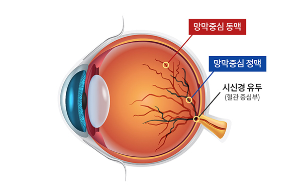 망막혈관폐쇄