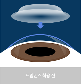 드림렌즈 착용 전