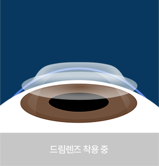 드림렌즈 착용 중