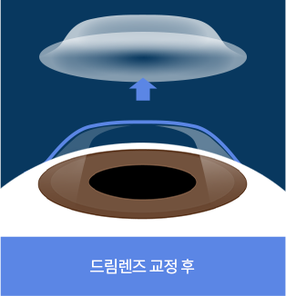 드림렌즈 교정 후