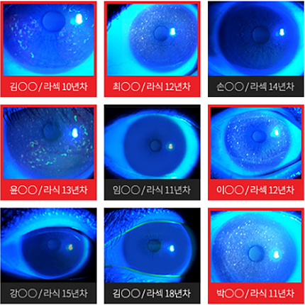 각막상피 검사 사진