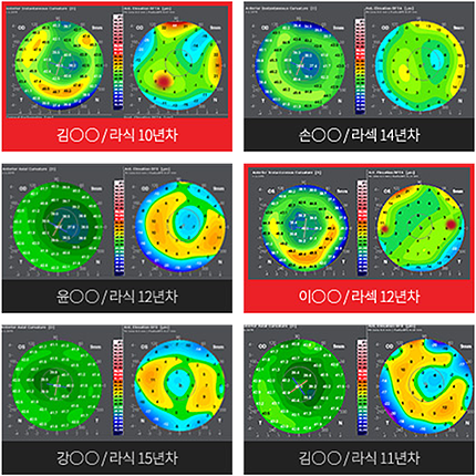각막지형도 검사 사진