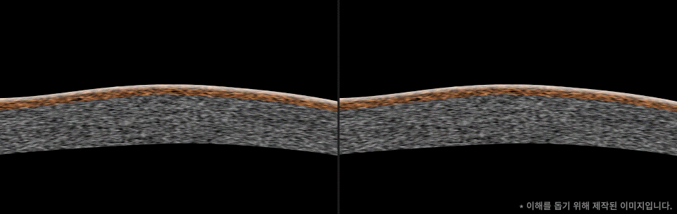 시력교정 각막절삭을 최소화하여 잔여각막을 최대 60%더 보존하다.
