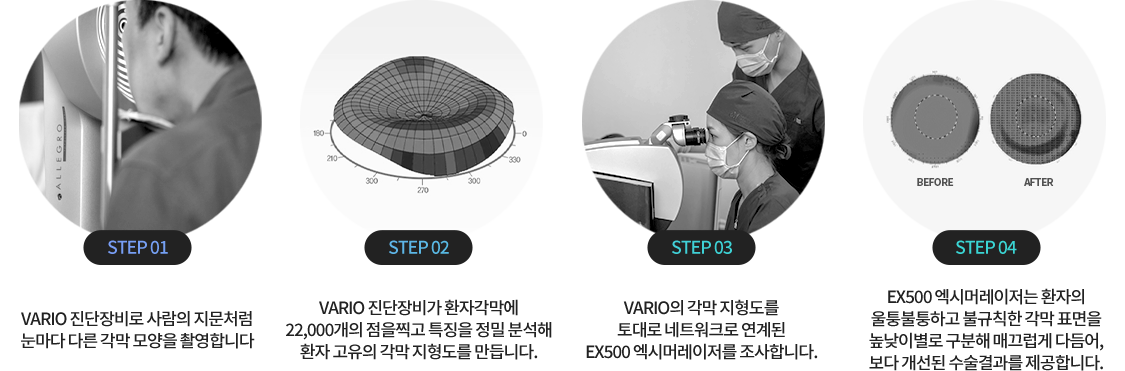 컨투라 비전 수술 과정