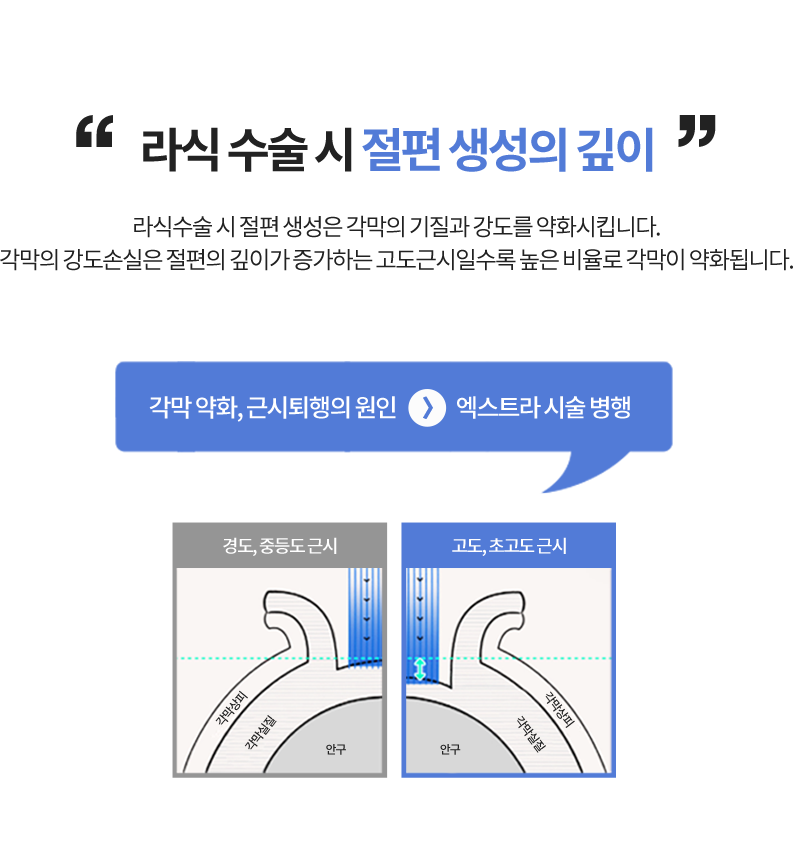 라식 수술 시 절편 생성의 깊이