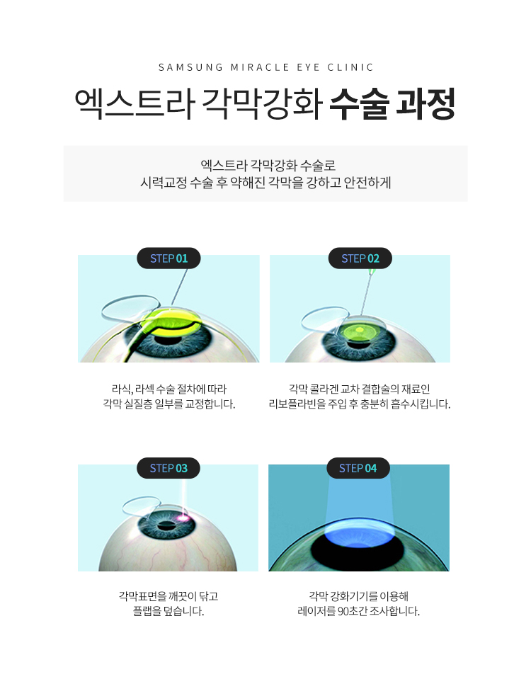 엑스트라 각막강화 수술 과정