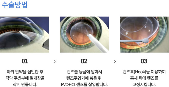 implant 상세03