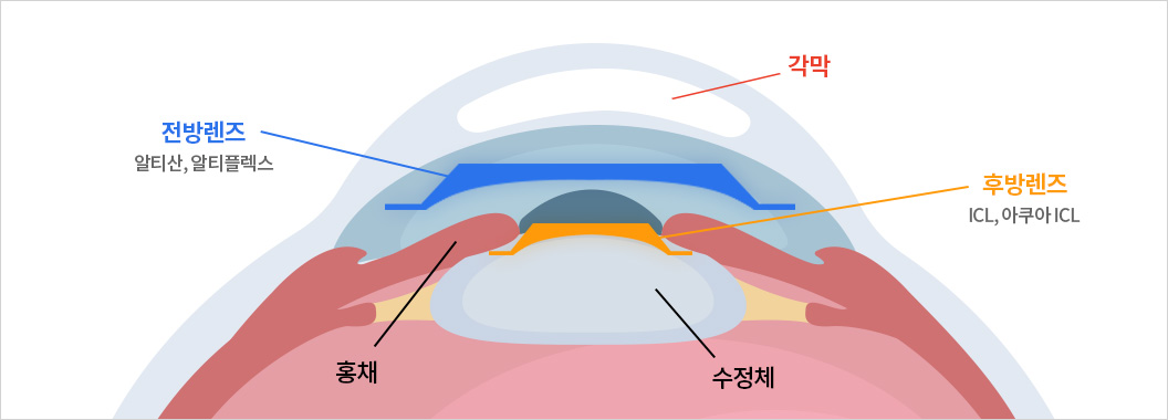 안내렌즈삽입술 수술시 전방렌즈/후방렌즈의 위치를 나타낸 그림